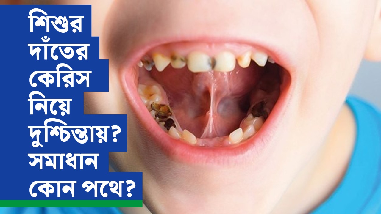 শিশুর দাঁতের কেরিস নিয়ে দুশ্চিন্তায়? সমাধান কোন পথে?