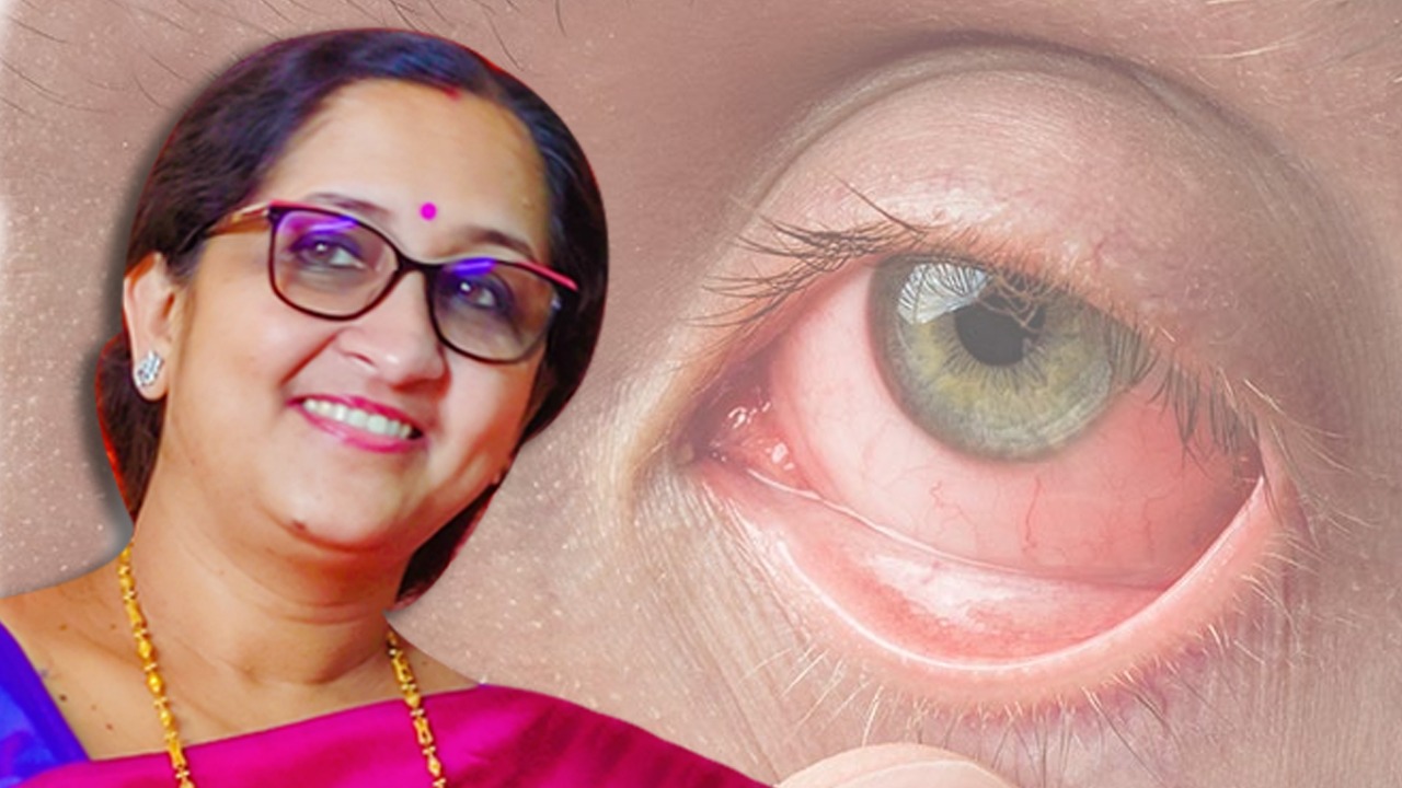 ‘কনজাঙ্কটিভাইটিস’? আলোচনায় বিশিষ্ট চক্ষুরোগ বিশেষজ্ঞ ডা: সৌম্যা কুন্ডু