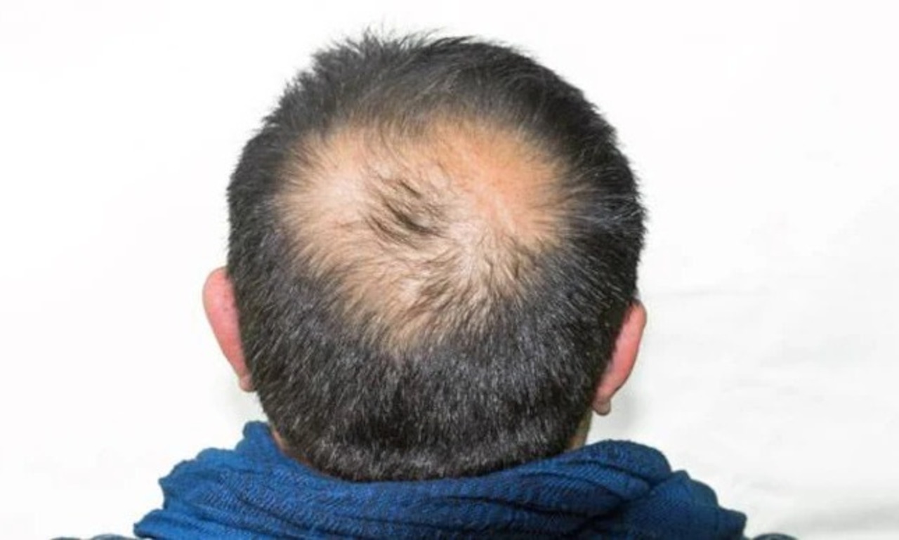 চুল পরার সমস্যায় কি আপনিও নাজেহাল?